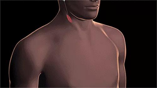 Cleveland-Clinic-Jugular-Stented-Heart-Valve