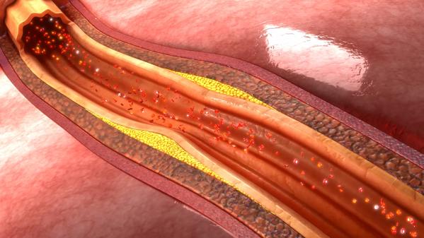 Coronary artery plaque