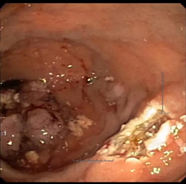 16-ddi-2083-polyp-cqd-inset