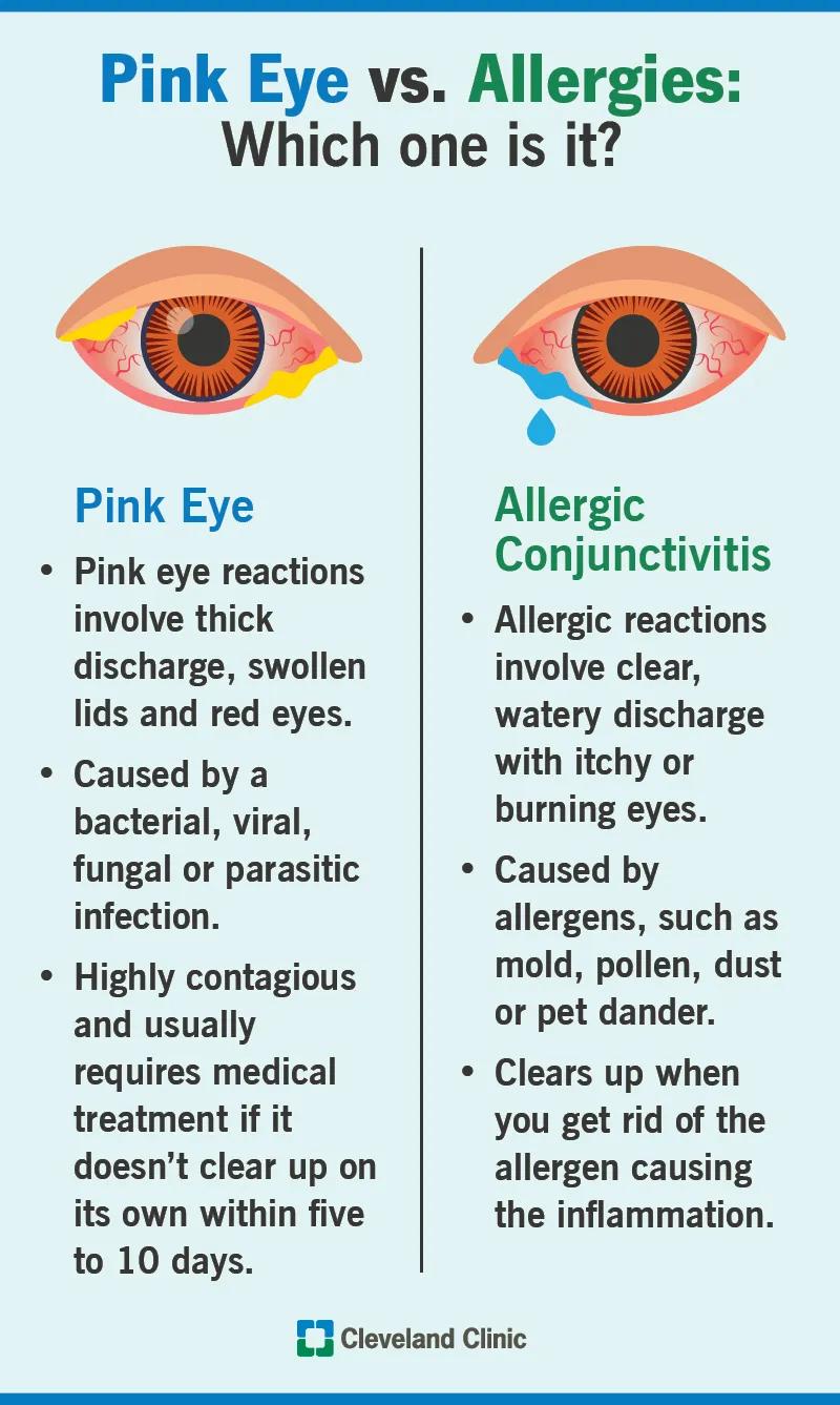 Pink eye vs. allergies