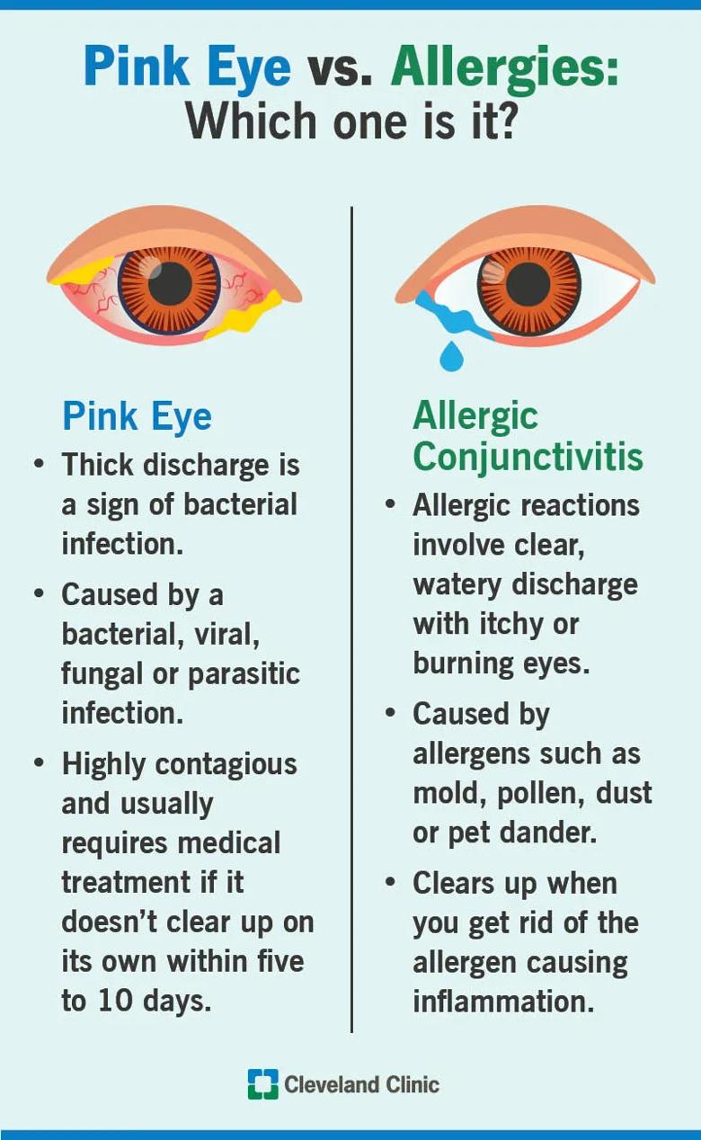 Pink eye vs. allergies