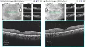 Optical coherence tomography showing the retinal pigment epithelium
