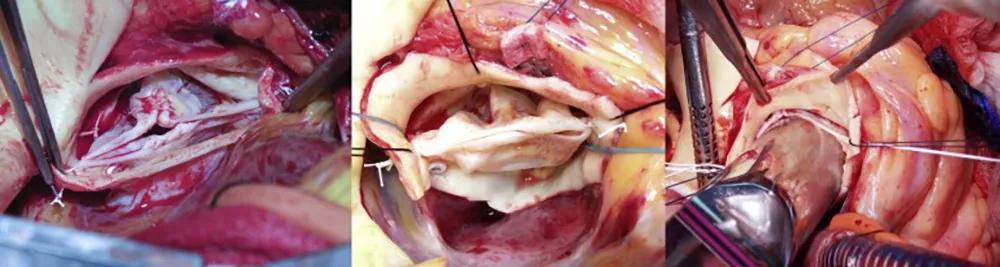 three intraoperative photos of a heart valve
