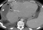 CT scan after second-stage hepatectomy, showing enlarged left lateral segment without radiologic evidence of tumor.