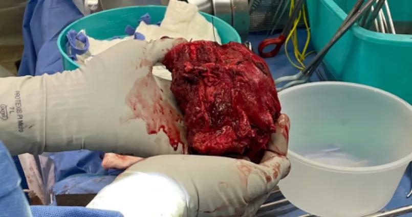 gloved hands holding a bloody mass removed in surgery