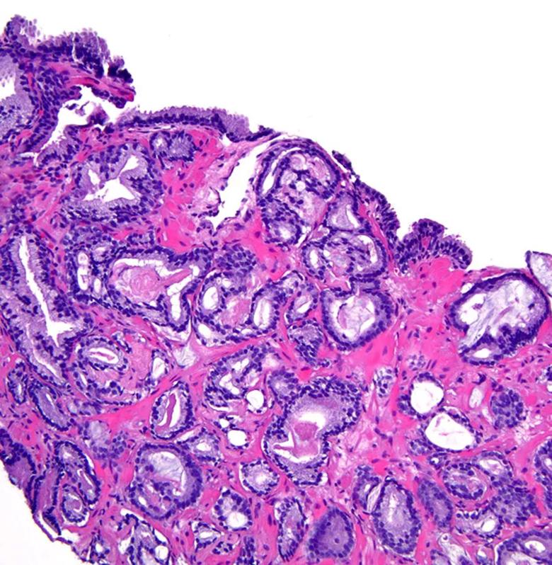 805x-Inset-McKenney Prostate