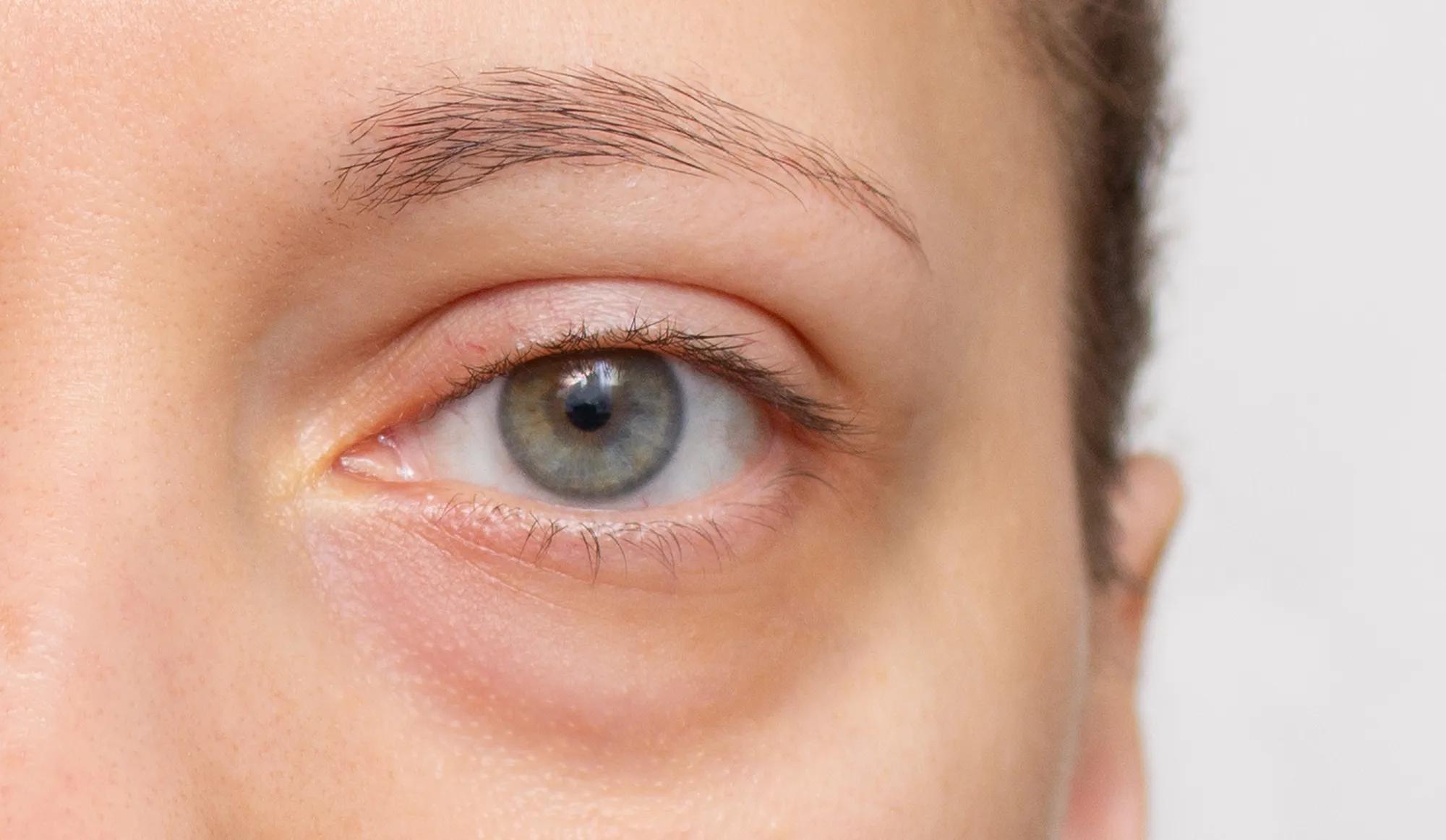 l carnitine eye bags L-Carnitine Benefits for Chronic Fatigue Syndrome Lactic acid is combined with three forms of vitamin C to increase absoption and enhance antioxidant performance for eye How To Get Rid of