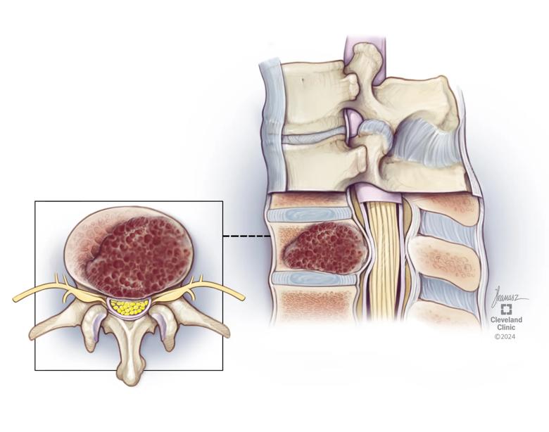 vascular hemangioma within spinal column