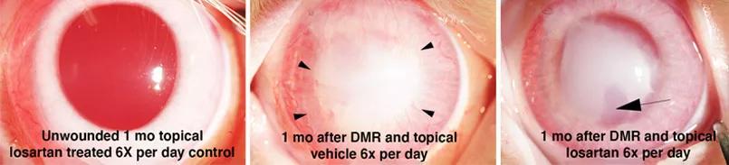 The first successful trial of topical losartan after removal of an 8 mm circle of Descemet’s membrane and endothelium