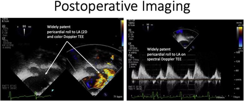 Postoperative transesophageal imaging 