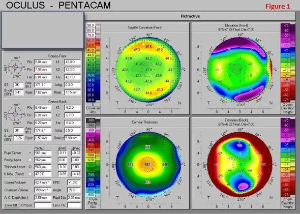 Enhancement 13 Years After Lasik