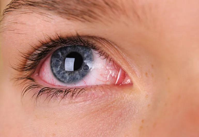 Can Bloodshot Eyes Be Serious? When to Seek Help, and eye closure