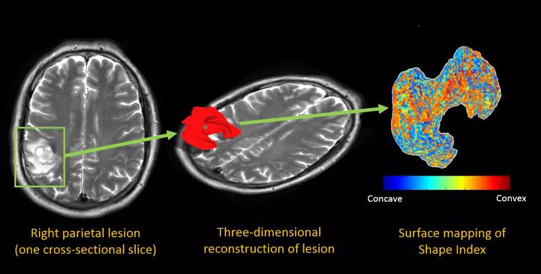 color maps of a right parient brain lesion