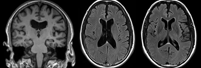 three brain MRIs side by side against black background