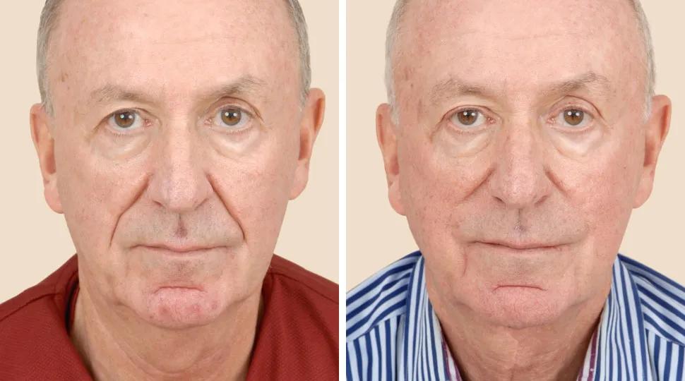 Front View - Before and After