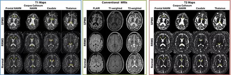 Figure 1. MRF-based T1 maps (left), conventional MRIs (middle) and MRF-based T2 maps (right) from patients with secondary progressive MS (SPMS, top rows), patients with relapsing-remitting MS (RRMS, middle rows) and healthy controls (bottom rows).