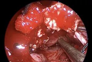 Dissection off of nasal floor and palate. Known expansile site of hard palate identified