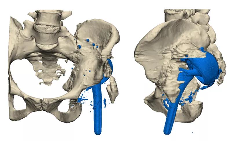 The patient’s initial condition and placement of original implants.