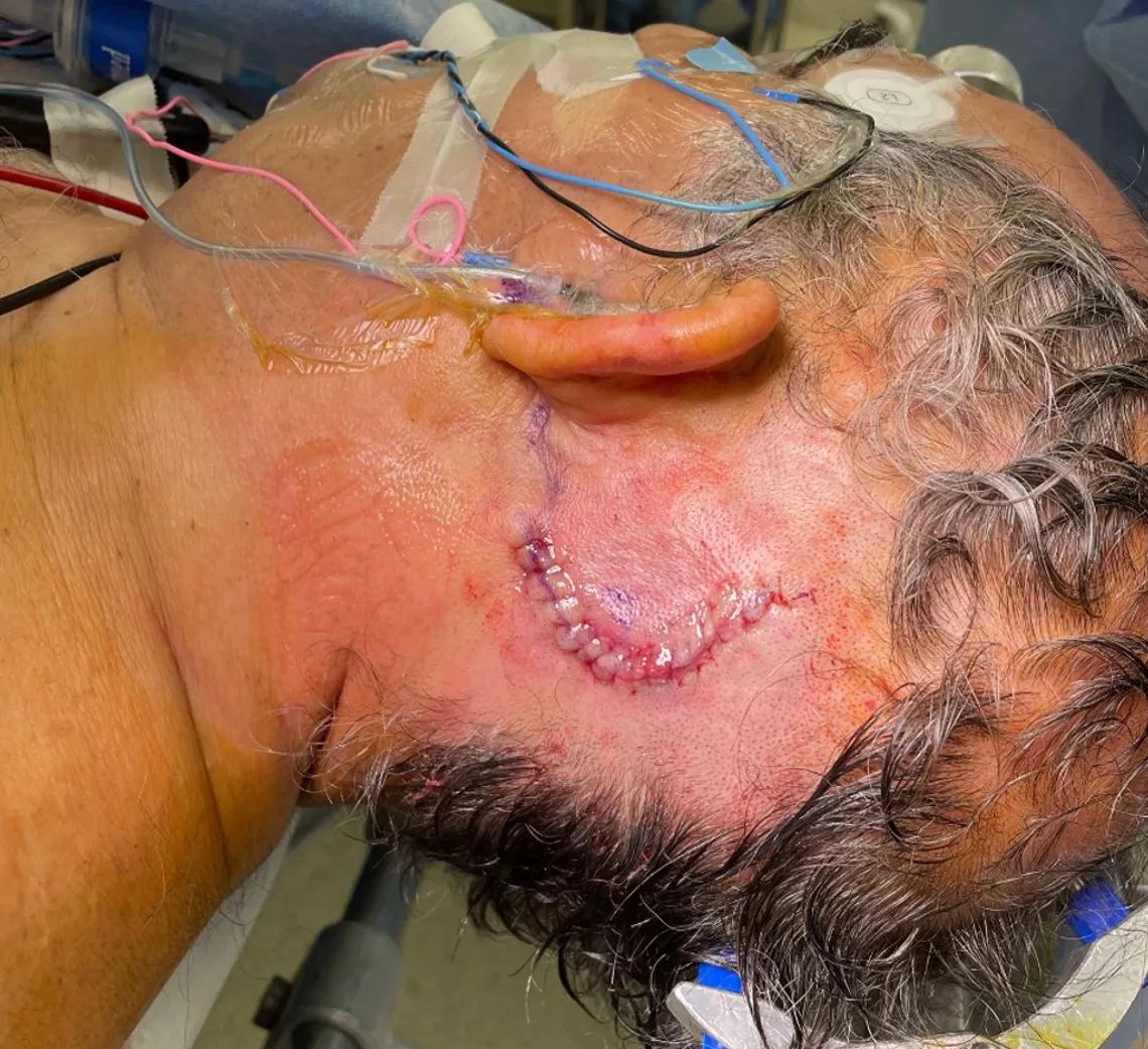 Incision immediately after minimally invasive microvascular decompression of trigeminal nerve