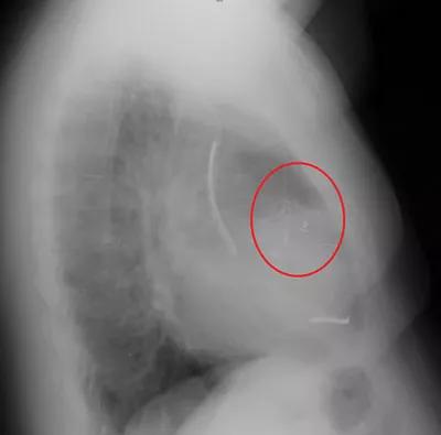 Figure 2. Lateral chest X-ray showing an anterior/anterolateral left ventricular pacing lead.