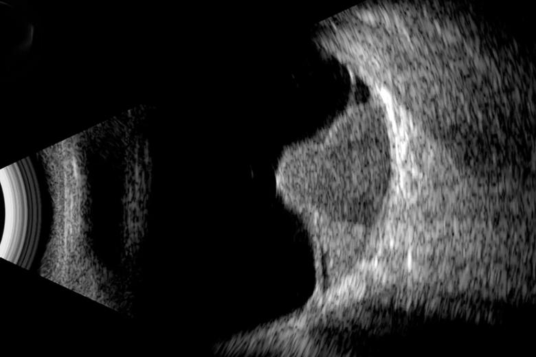 Uveal melanoma