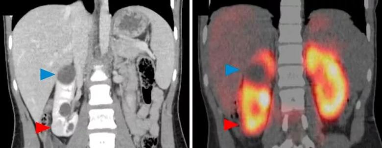 Coronal contrast-enhanced computed tomography shows a smaller 2.0-cm, solid renal mass in the lower pole of the kidney.
