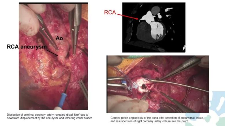 intraoperative photos of surgery for congenital heart disease