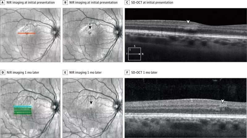 16-eye-1562-octa-cqd-fig2