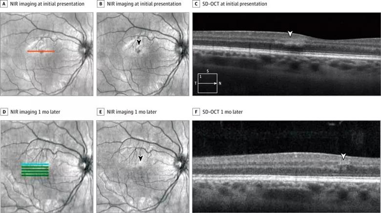 16-eye-1562-octa-cqd-fig2