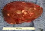 Resected extended right lobe.