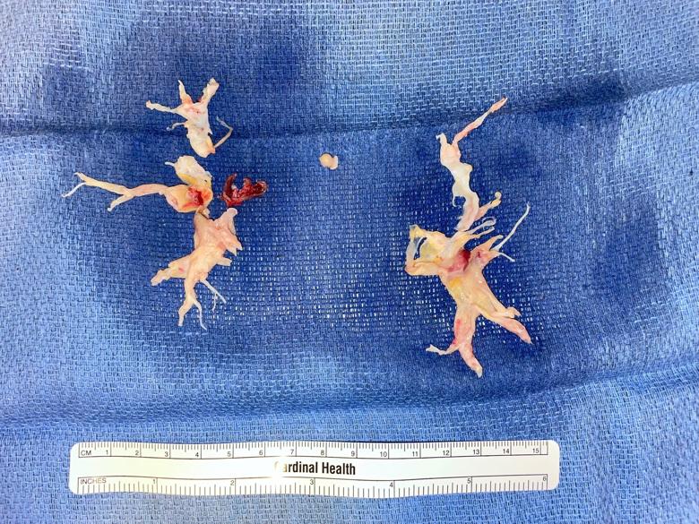 thromboembolic material