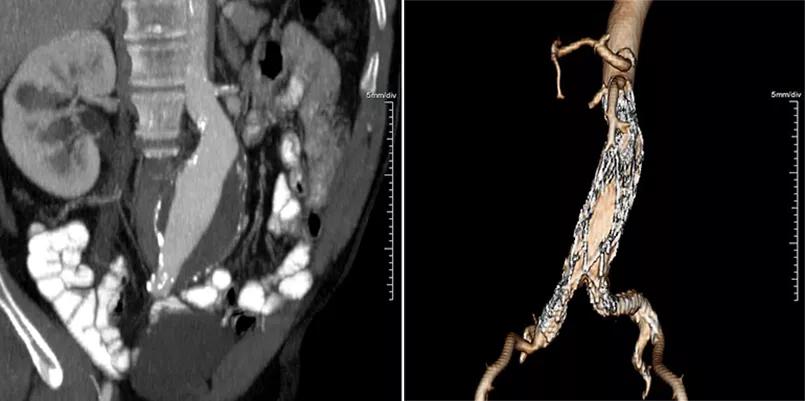 CT scans