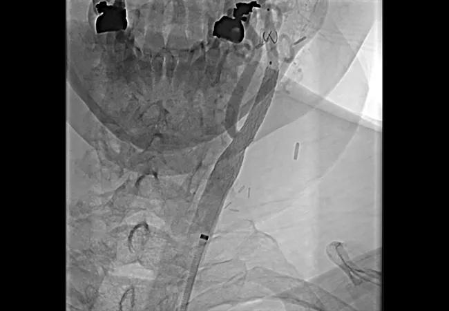 Advances Have Put Carotid Artery Stenting on Par With Surgery for