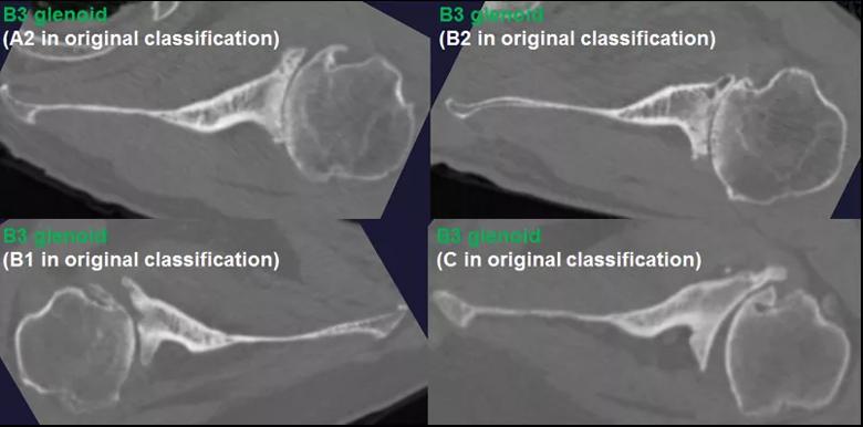 Shoulder arthritis