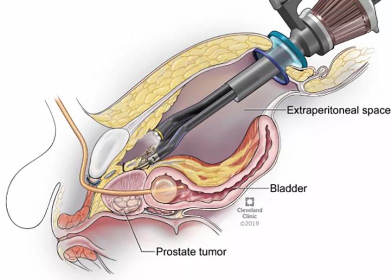 Figure 1. Extraperitoneal Single Port Radical Prostatectomy. Note the surgical space above the bladder but outside the peritoneal sac.