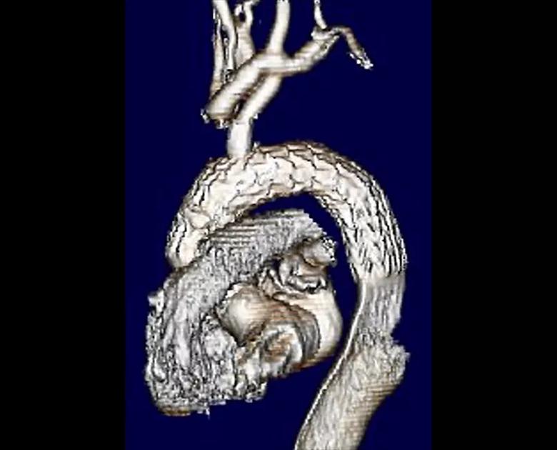completed hybrid aortic repair on 3D CT