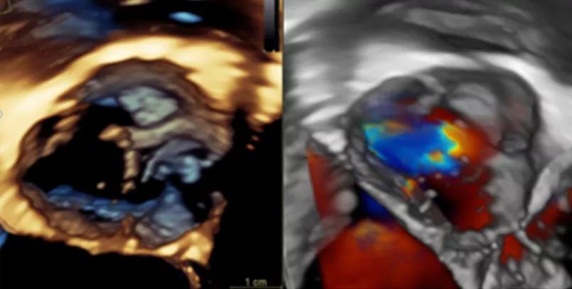 Aortic valve
