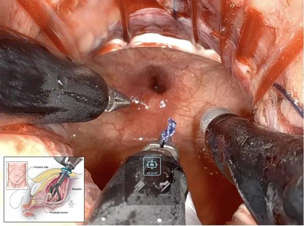 intraoperative view of single-port transvesical radical prostatectomy 