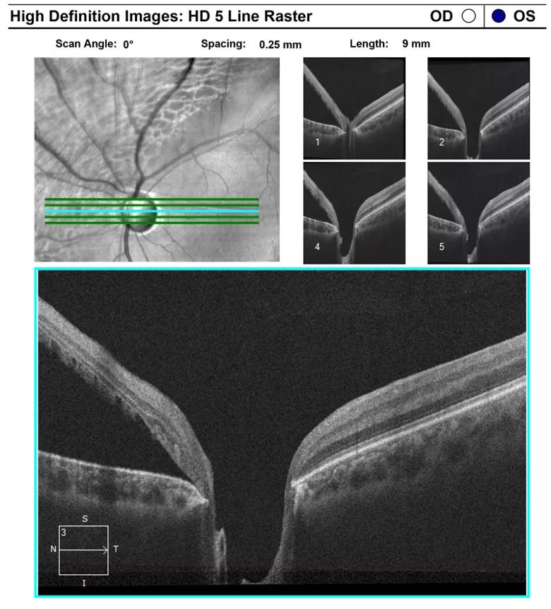  A large retinal detachment is seen with subretinal fluid extending right up to the optic disc.