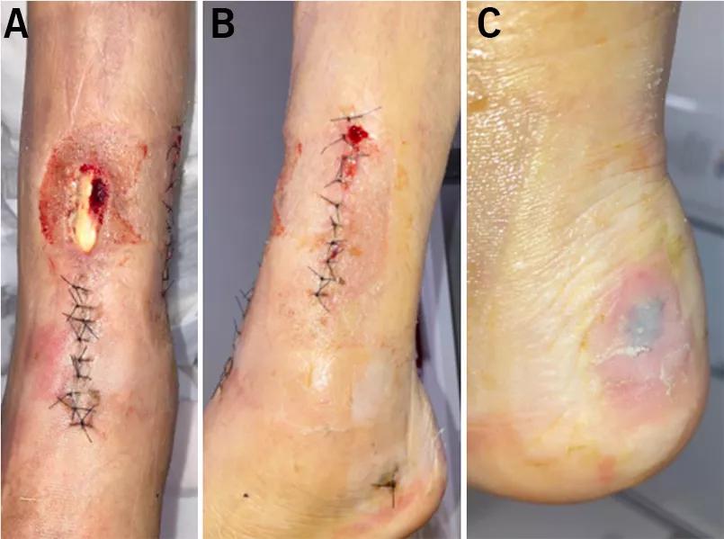 Pretibial wound with exposed anterior tibial tendon