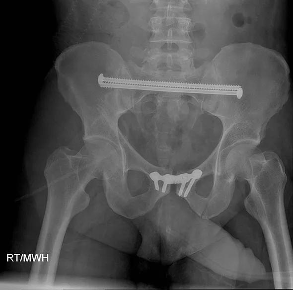 Figure 3. Postoperative anteroposterior pelvis view