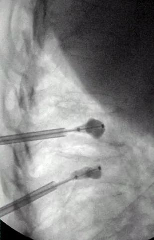 Cancer Pain Figure-2.1