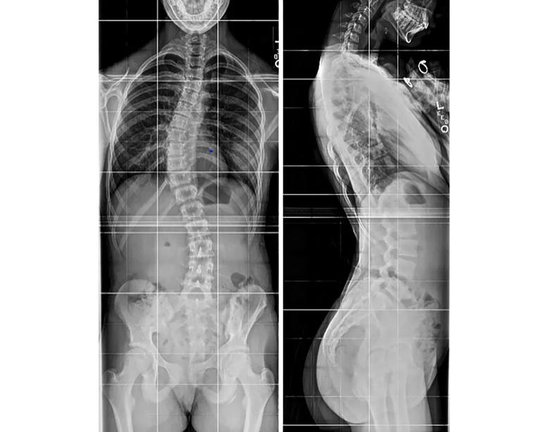 X-ray of scoliosis