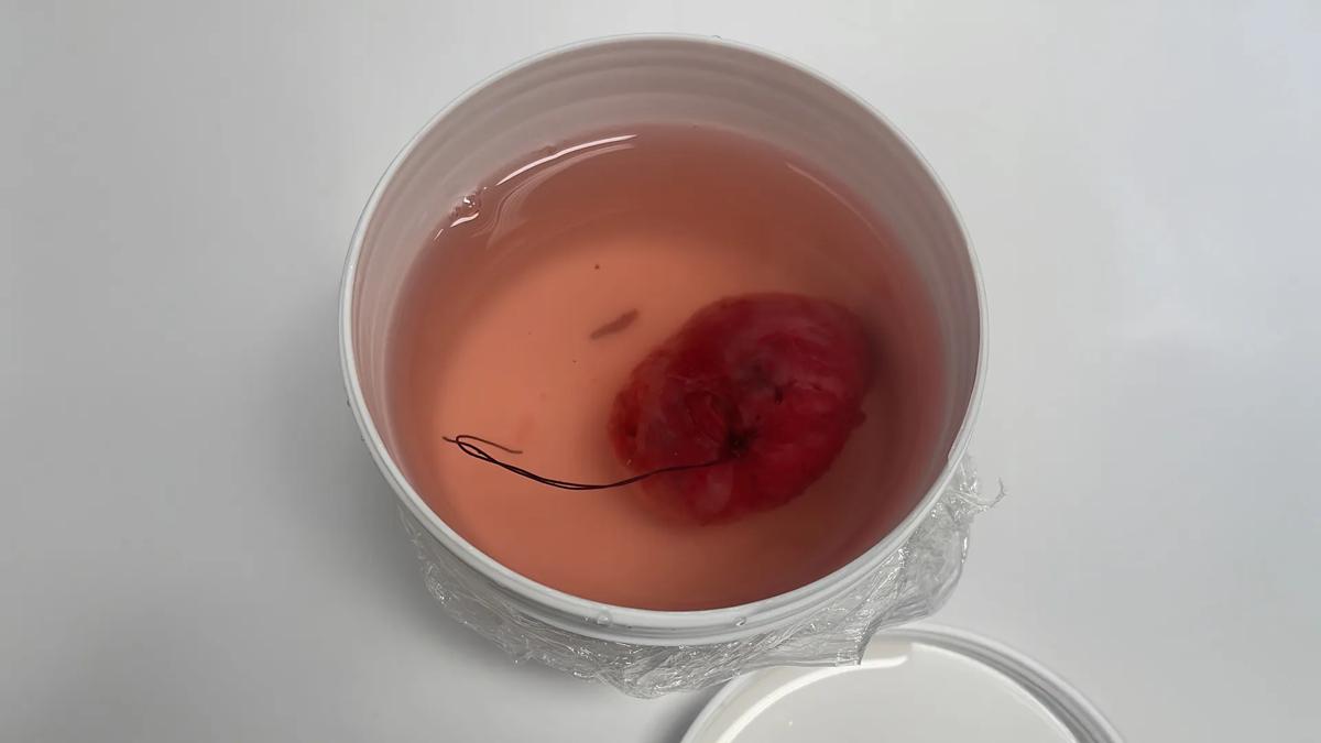 Excised tumour