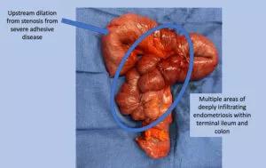 The terminal ileum and colon with deeply infiltrating endometriosis.