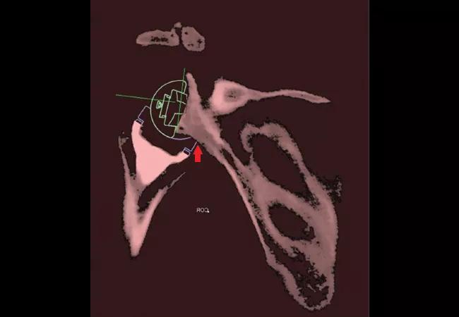 Scapular Notching Following Reverse Total Shoulder Arthroplasty