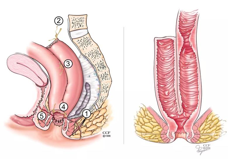 Anatomy of ileal pouch anal anastomosis (IPAA). Patients who