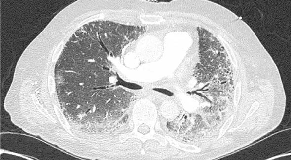 Figure 1. Thoracic high-resolution CT scan in a 66-year-old man with interstitial lung disease and fibrosis associated with antisynthetase (anti-Jo-1) syndrome. Note the bilateral patchy ground-glass opacities suggestive of active alveolitis, most extensive at the lung bases, along with bilateral subpleural reticular infiltrates and interlobular septal thickening.